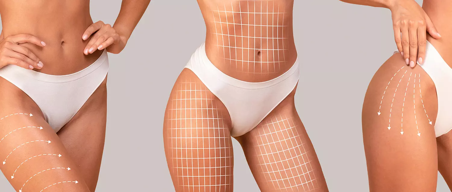 Tratamiento Coporal anticelulitis y piel de naranja en Madrid. Centro Estetica Integral